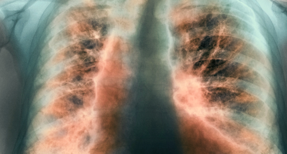 Idiopathic pulmonary fibrosis.jpg